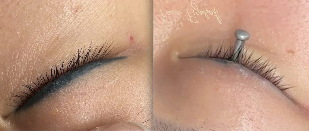 Eyeliner tattoo removal