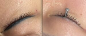 Eyeliner Tattoo Removal